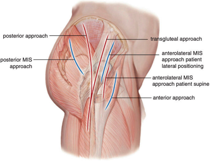 Medical illustration showing the anterior approach hip replacement corridor between the tensor fasciae latae and sartorius muscles, with no muscle detachment required